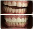 مرکز دندانپزشکی دکتر جنانی / دکتر برهانی - اصلاح طرح لبخند