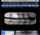 مرکز دندانپزشکی دکتر جنانی / دکتر برهانی - پوسیدگی بین دندانی