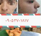 جراحی بینی گروه پزشکان لوتوس - تصویر 51495