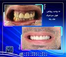 کلینیک دندانپزشکی پارسه - روكش فول سرام