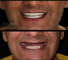 دندانپزشکی دیجیتال دکتر حسین توسلی زاده - ایمپلنت