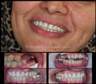 دندانپزشکی دیجیتال دکتر حسین توسلی زاده - لمینیت و ایمپلنت