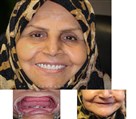 دندانپزشکی دیجیتال دکتر حسین توسلی زاده - اوردنچر