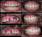 دندانپزشکی دیجیتال دکتر حسین توسلی زاده - سینوس لیفت، ایمپلنت و لمینیت 