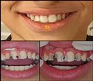 دندانپزشکی دکتر حسین توسلی زاده - پوسیدگی های شدید در اطفال، ترمیم های کامپوزیت همرنگ دندان 