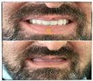 دندانپزشکی دکتر حسین توسلی زاده - بازسازی دو فک