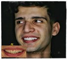 دندانپزشکی دکتر حسین توسلی زاده - جراحی لثه و ونیر کامپوزیت با فرم طبیعی و رنگ روشن