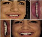 دندانپزشکی دکتر حسین توسلی زاده - ونیر کامپوزیت با لبه های شیشه ای 