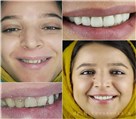دندانپزشکی دکتر حسین توسلی زاده - بازسازی و طراحی لبخند با روکش های سرامیک 