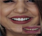دندانپزشکی دکتر حسین توسلی زاده - طراحی لبخند با کامپوزیت لیرینگ