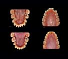 فتوگرافی پزشکی و رادیولوژی رویان - قبل و بعد داخل دهانی