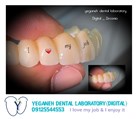 لابراتوار دیجیتال تخصصی پروتزهای دندانی یگانه - Zirconia