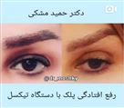کلینیک تخصصی زیبایی دکتر حمید مُشگی - رفع افتادگی پلک با دستگاه تیکسل