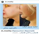 کلینیک تخصصی زیبایی دکتر حمید مُشگی - لیپوساکشن غبغب