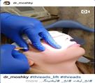کلینیک تخصصی زیبایی دکتر حمید مُشگی - لیفت با نخ 