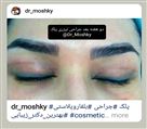 کلینیک تخصصی زیبایی دکتر حمید مُشگی - جراحی پلک