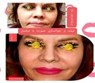 کلینیک تخصصی زیبایی دکتر حمید مُشگی - جوانسازی و لیفت صورت با تیکسل