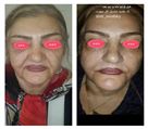 کلینیک تخصصی زیبایی دکتر حمید مُشگی - جوانسازی و لیفت صورت با تیکسل