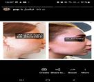 کلینیک تخصصی زیبایی دکتر حمید مُشگی - زاویه سازی فک