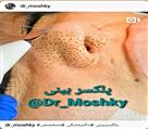 کلینیک تخصصی زیبایی دکتر حمید مُشگی - پلکسر بینی