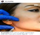 کلینیک تخصصی زیبایی دکتر حمید مُشگی - زاویه سازی فک