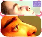 کلینیک تخصصی زیبایی دکتر حمید مُشگی - nose job فیلر بینی 