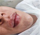 مطب دکتر سحر صمدی صوفی - فیلر لب