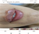 مطب دکتر سحر صمدی صوفی - فیلر لب