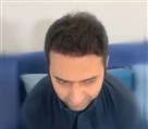 مرکز کاشت مو و ابرو هرمین - تصویر 117518