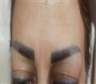 مرکز کاشت مو و ابرو هرمین - قبل از کاشت ابرو