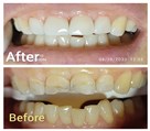 مطب دندانپزشکی دکتر لیدا وکیل التجار - لمینیت ۴ دندان جلو بالا و بلیچینگ 