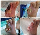 کلینیک درمان زخم و دیابت مهرشهر - درمان زخم دیابت 