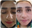 کلینیک تخصصی لاغری و لیزر اوکتا - رفع لک صورت با لیزر