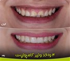 کلینیک دندانپزشکی نیکان اهواز - نمونه کار قبل و بعد کامپوزیت