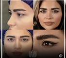 کیلنیک زیبایی مهرزاد - بلفارو پلاستی😍