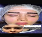 کیلنیک زیبایی مهرزاد - بلفارو پلاستی