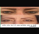 کیلنیک زیبایی مهرزاد - قبل و بعد بلفارو پلاستی رفع افتادگی پلک شما🌹