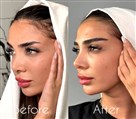 کیلنیک زیبایی مهرزاد - کاشت ابرو بصورت دونه ای Fit نچرال 😍