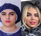 کیلنیک زیبایی مهرزاد - قبل و بعد جراحی بینی کلینیک مهرزاد❤️