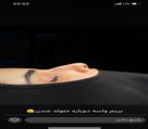 کیلنیک زیبایی مهرزاد - قبل از جراحی بینی🥲