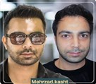 کیلنیک زیبایی مهرزاد - کاشت شقیقه