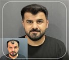 کیلنیک زیبایی مهرزاد - کاشت شقیقه 