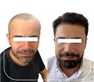 کیلنیک زیبایی مهرزاد - خدمات کاشت مو