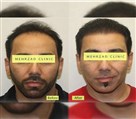 کیلنیک زیبایی مهرزاد - کاشت قسمت جلوی سر