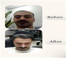 کیلنیک زیبایی مهرزاد - کاشت کامل کف سر