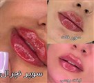 کیلنیک زیبایی مهرزاد - متد های تزریق مهرزاد