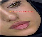 کیلنیک زیبایی مهرزاد - لیفت فلت روسی😍