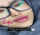 کیلنیک زیبایی مهرزاد - تزریق ژل لب😍