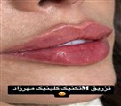 کیلنیک زیبایی مهرزاد - تزریق فیلر بصورت M تکنیک