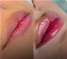 کیلنیک زیبایی مهرزاد - تزریق فیلر لب بصورت نچرال 